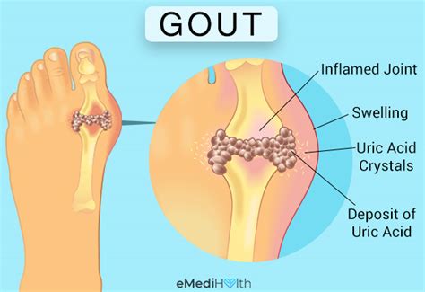 You could also apply an antibacterial or antiseptic gel to the swollen area and then bandage the injury. How to Ease a Gout Attack: Treatment and Home Remedies