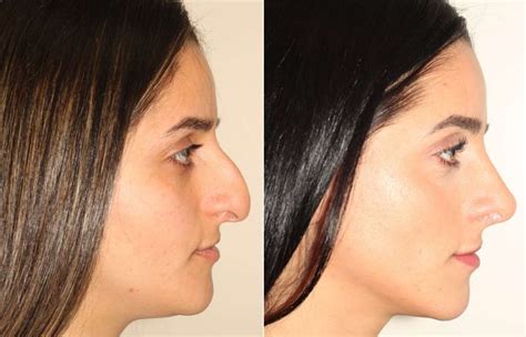 A Natural Looking Nose Job In Vancouver Dr Denton