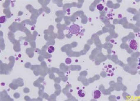 Peripheral Smear Large Platelets With Profuse Platelet Clumps Are