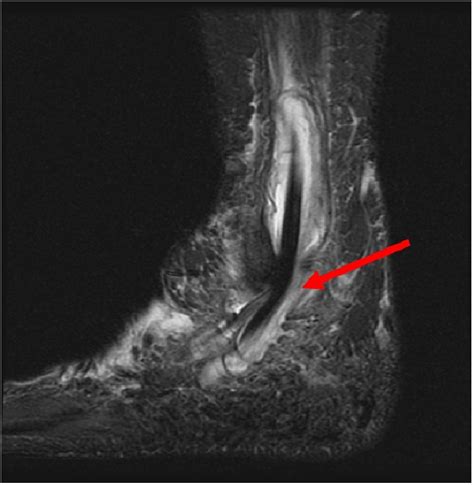 Cureus Idiopathic Peroneal Tenosynovitis Caused By A Previously