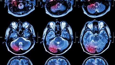 The golden ratio is one of the most famous irrational numbers; Golden Hour is Vital for Treating More Severe Strokes ...