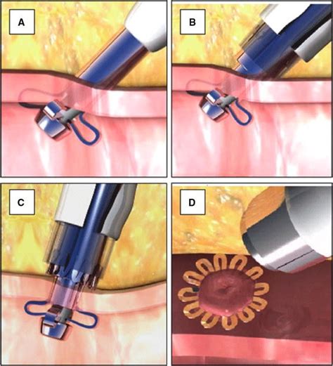 Vascular Closure Devices In Interventional Radiology Practice