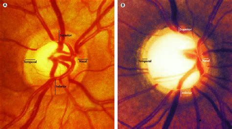 Normal Optic Disc A And Glaucomatous Optic Nerve Head Open I My Xxx