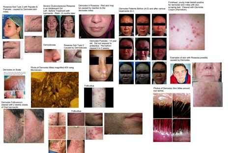 Demodex Skin Mites Can Cause Acne Like Skin Disease Overlooked By