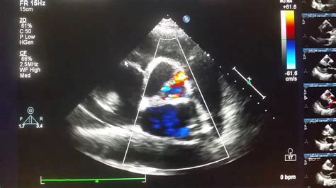 Echocardiogram Aortic Dissection With Severe Aortic Regurgitation