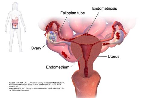Hormone therapy for endometriosis and surgical. Endometriosis Treatment in Ayurveda - Ayurwoman Ayurveda ...