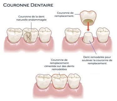 Couronne Dentaire