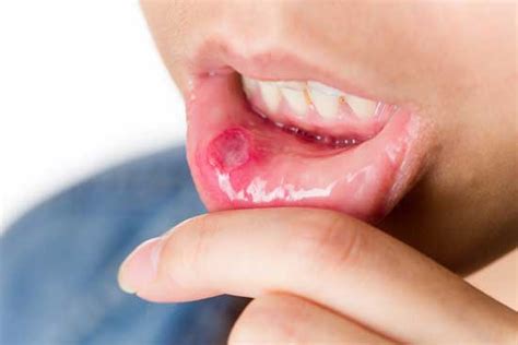 Hiv Mouth Sores Different Types And How To Treat Them Evolving World