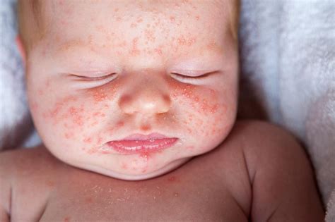 Hautausschläge Bei Babys Und Kindern Bedingungen 2024