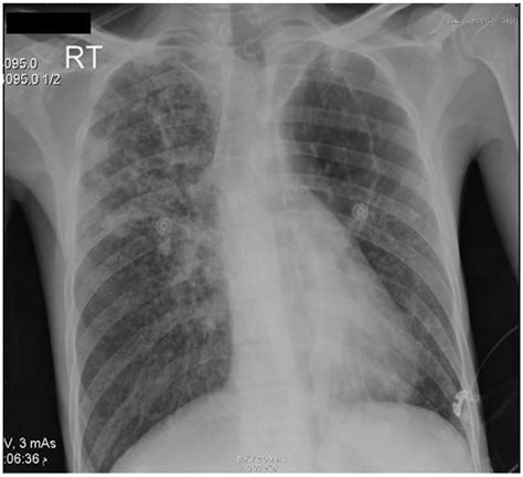 Chest X Ray Showing Bilateral Reticulonodular Opacities With Some