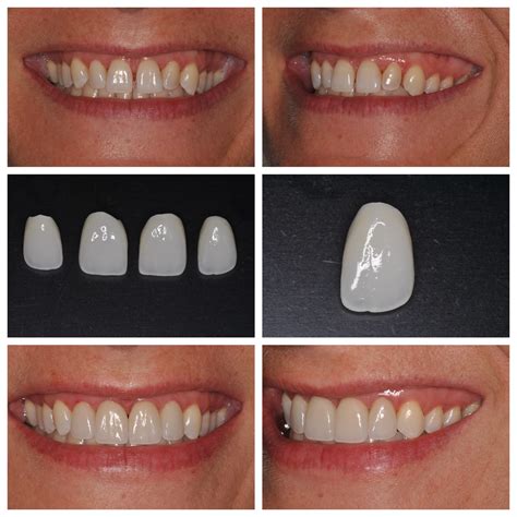 Smile Spotlight Amy Love Your Smile With Porcelain Veneers