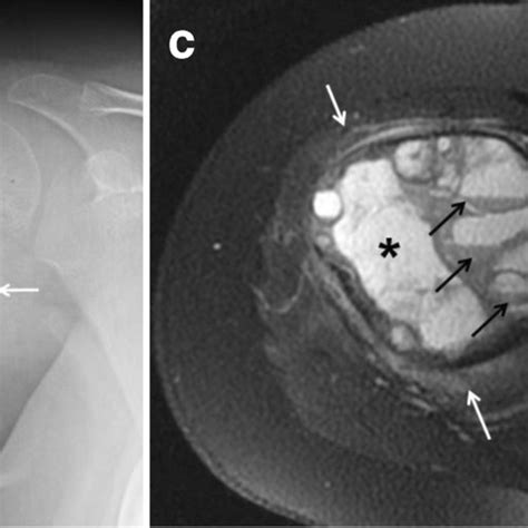 Rapid Progression Of A Proximal Humeral Aneurysmal Bone Cyst From A