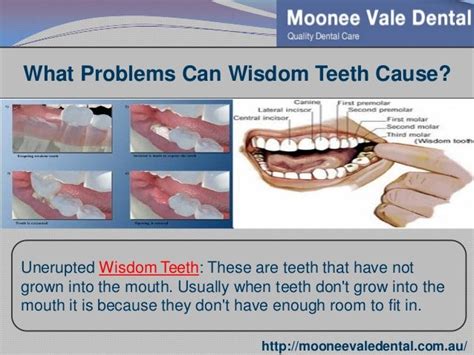 How Can Wisdom Teeth Cause Problems Teethwalls