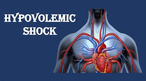 The airway should be assessed for patency. Hypovolemic Shock in Hindi - YouTube