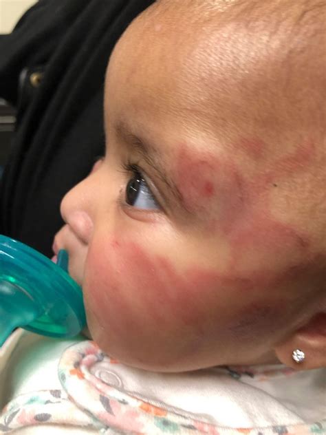 Infant Leaves New Jersey Daycare Covered In Bruises