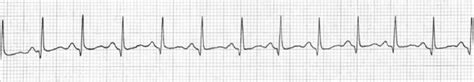 Virtual Pediatric Hospital: CQQA: EKG