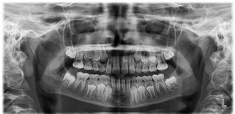 X Ray Of 9 Year Old Teeth