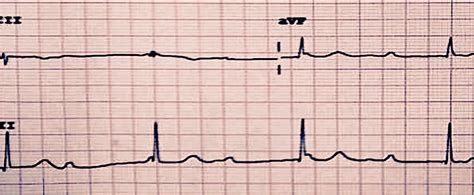 Ecg 81 Bloqueos Auriculoventriculares Cardio Science