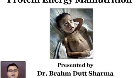 Protein Energy Malnutrition Pem Kwashiorkor And Marasmus In Hindi