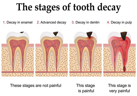 Facts About Tooth Decay Brunelli Dental Partners