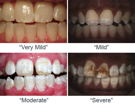 Teeth Fluorosis 4 Things You Must Know Nha Khoa Bedental