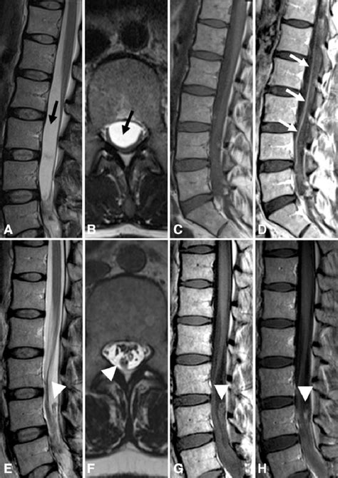 Lumbar Spine Mri Anatomy