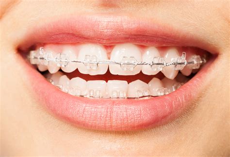 Fixed Metal And Ceramic Braces Wirral Buckle Wirral Dentists