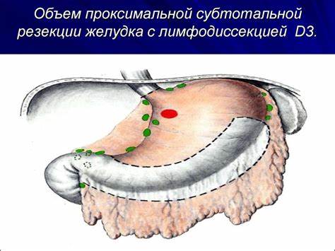 Диета послеоперационная при резекции желудка Рак желудка - презентация онлайн Рак желудка - презентация онлайн Диета послеоперационная при резекции желудка
