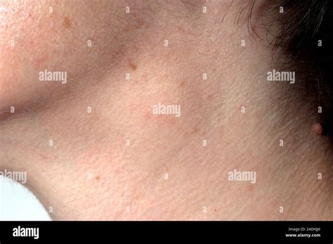 Swollen Glands On The Side Of A 40 Year Old Womans Neck This