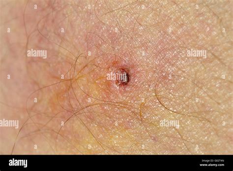 Entzuendeter Zeckenbiss Infected Tick Bite On Thigh Stock Photo Alamy