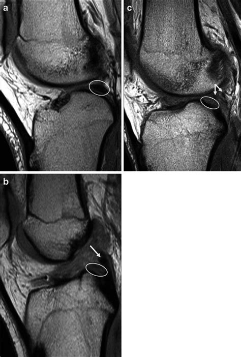 Posterior Attachment Of Lateral Meniscus A Normal Appearance On