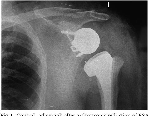 Figure 2 From Arthroscopic Reduction Of A Chronically Dislocated