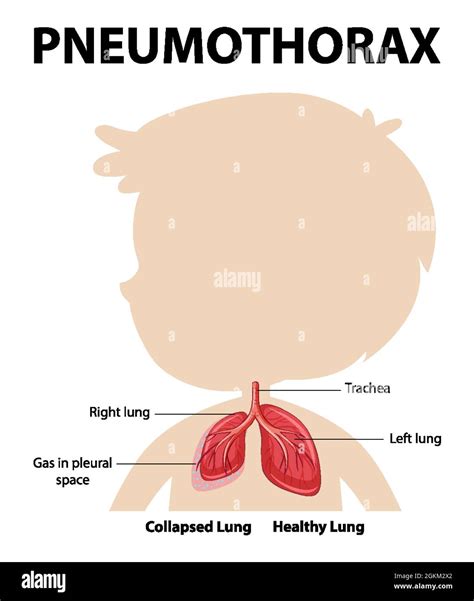 Pneumothorax Diagram Of Human Anatomy Illustration Stock Vector Image