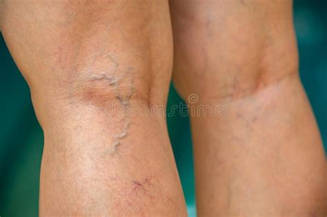 Clogged Veins Stock Photos Free Royalty Free Stock Photos From
