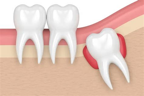 Dentigerous Cyst What Is It Risks And Treatments