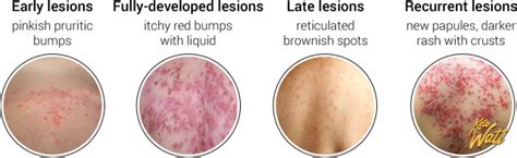 Keto Rash Guide Causes And Remedies For Low Carb Itch