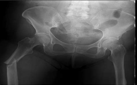 Signs Of Insufficiency Fractures Overlooked In A Patient Receiving