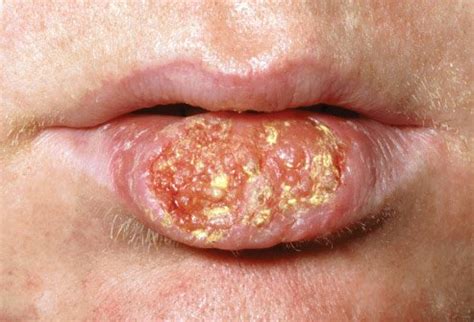 Cancers that form on the vocal cords can often cause hoarseness or a change in the sound and pitch of your voice; Head and Neck Cancers: Symptoms and Treatments