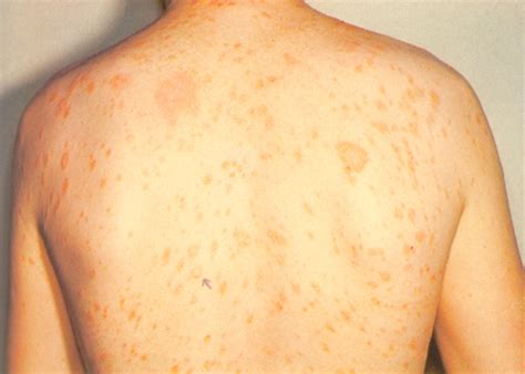 Pityriasis Rosea Herald Patch Medical Information