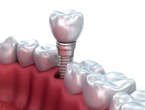 The dental care cost estimator provides an estimate and does not guarantee the exact fees for dental procedures estimates should not be construed as financial or medical advice. Single Tooth Replacement Options & Cost | Dental Implants ...