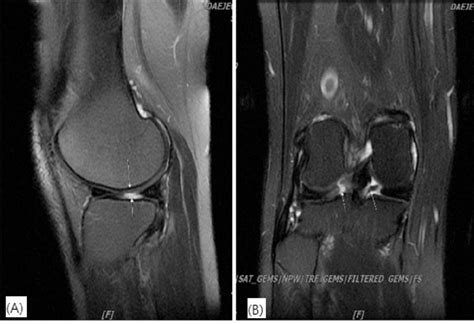 Mri Of Right Knee T2 A Sagittal View B Coronal View Download