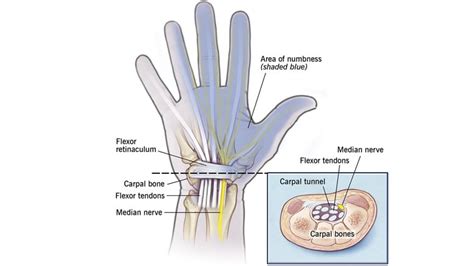 Symptoms And Risk Factors Of Carpal Tunnel Syndrome Entirely Health