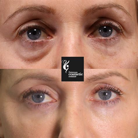 Non Surgical Tear Trough Or Eye Bag And Under Eye Filler Treatments Melbourne