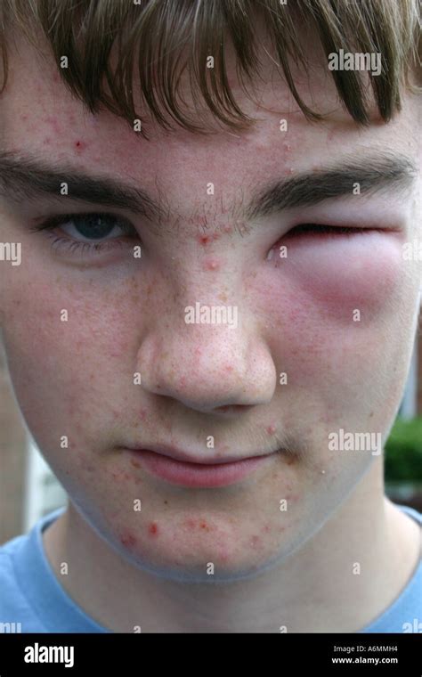 Spotty Teenage Boy With Swollen Eye Caused By Wasp Sting Stock Photo