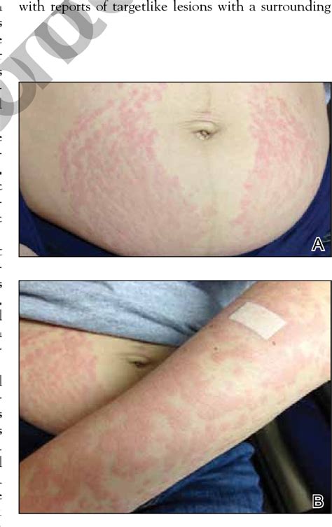 Figure 1 From Pruritic Urticarial Papules And Plaques Of Pregnancy