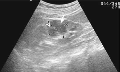 How much are 11.3 millimeters in centimeters? Renal Cystic Disease | Radiology Key