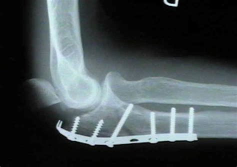 Plate Fixation Of Olecranon Fracture Wheeless Textbook Of Orthopaedics