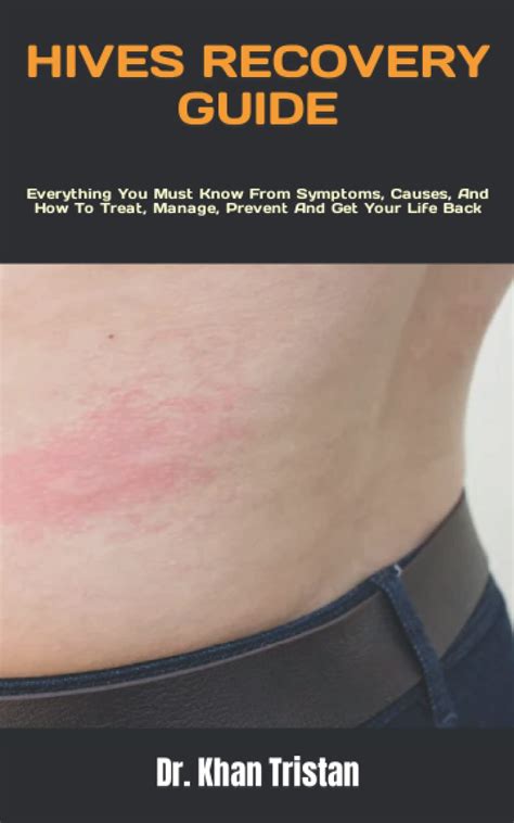 Buy Hives Recovery Guide Everything You Must Know From Symptoms