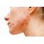 Identifying Different Types Of Acne  Allen Taintor Dermatology