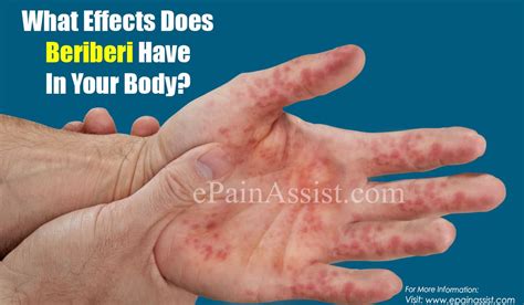 What Effects Does Beriberi Have In Your Body And Can Beriberi Be Cured